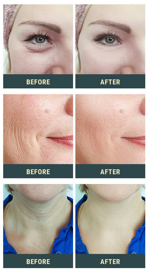 Seri Skin before and after results — reduced fine lines and improved skin texture in 28 days